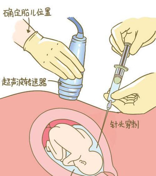 浙江省羊水孕期亲子鉴定